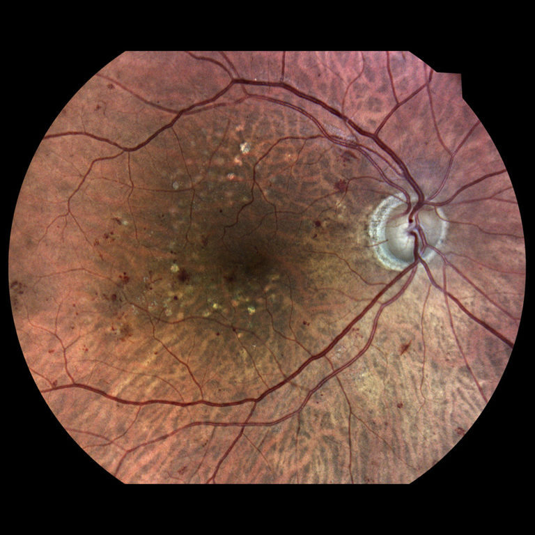 Diabetická retinopatia