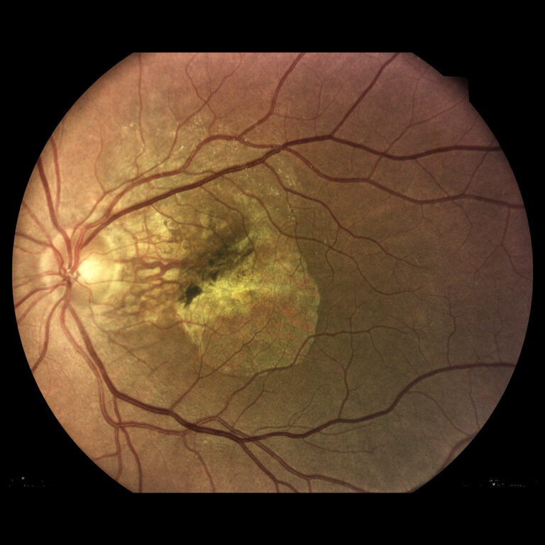 Vekom podmienená makulárna degenerácia (VPMD)